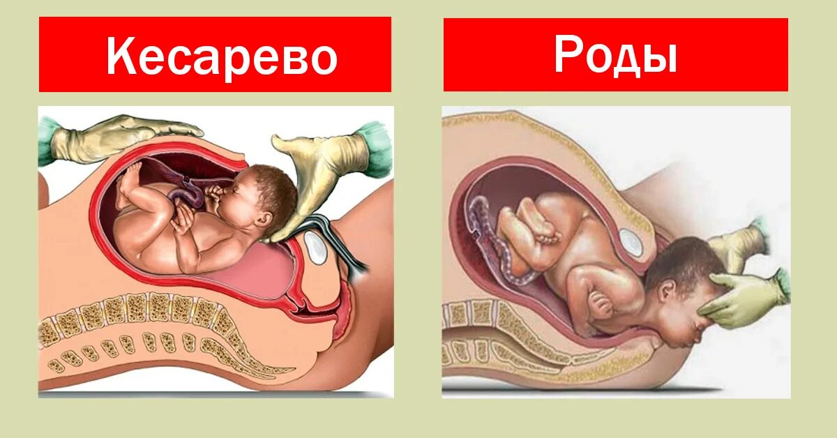 Естественные родовые пути. Рождение ребенка кесарево сечение. Роды 2 3 недели