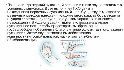 Разрыв разгибателя пальца мкб. Разрыв разгибателя пальца мкб
