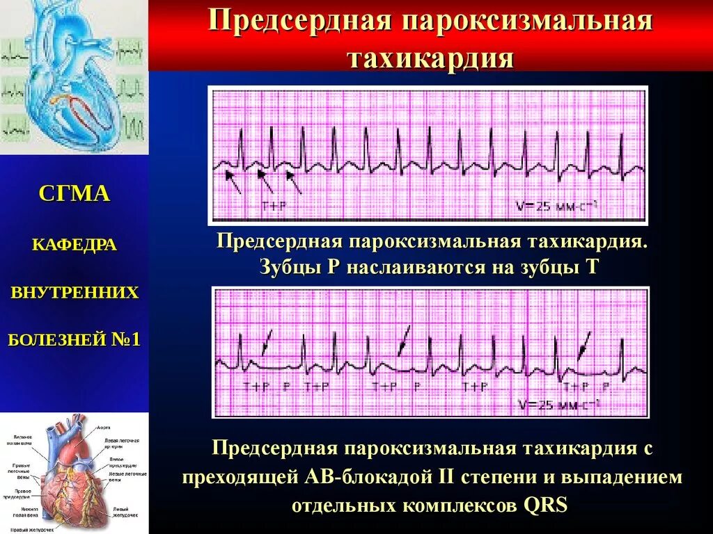 Предсердная пароксизмальная тахикардия на ЭКГ. ЭКГ-критерии пароксизмальной предсердной тахикардии. ЭКГ при предсердной пароксизмальной тахикардии. Пароксизмальная предсердная тахикардия с АВ блокадой 1 степени.