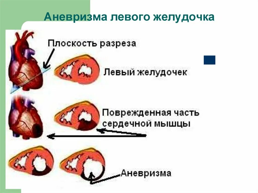 Аневризма сердца что это такое симптомы. Постинфарктная аневризма левого желудочка симптомы. Аневризма левого желудочка клинические рекомендации. Хроническая постинфарктная аневризма. Постинфарктная аневризма левого желудочка клинические рекомендации.