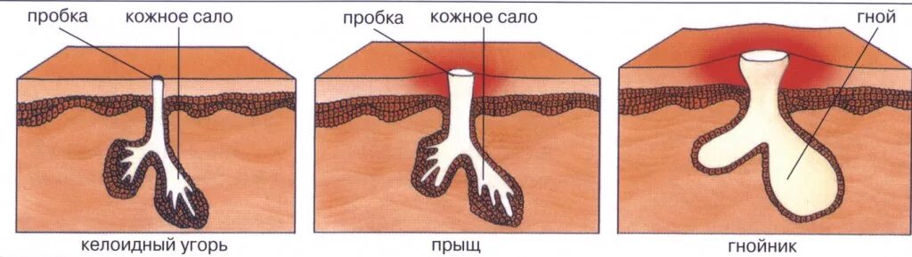 Плотный долго. Абсцедирующий фурункулез. Стадии заживления фурункула.