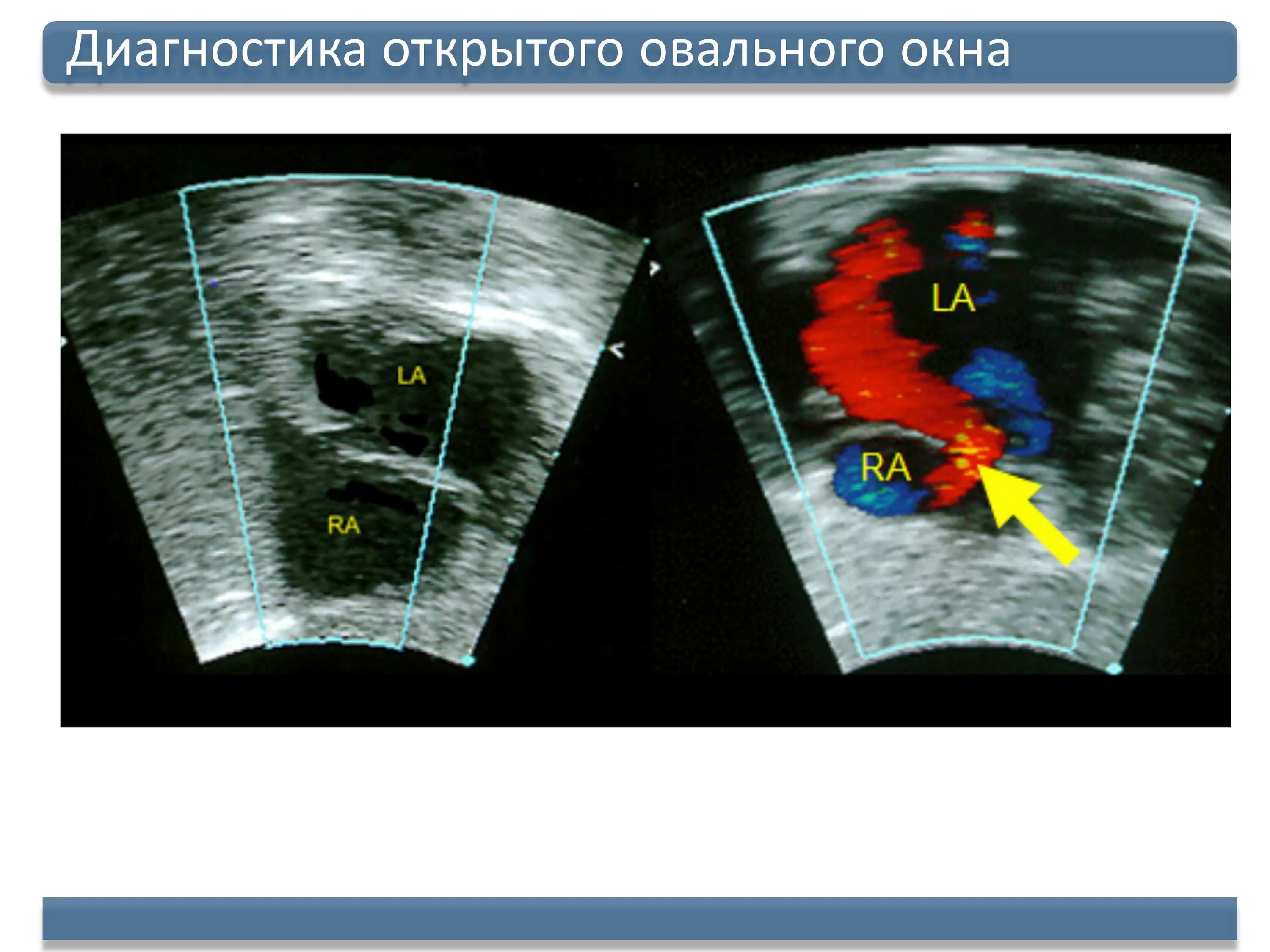 Где находится овальное окно. Открытое овальное окно диагноз. Открытое овальное окно в сердце у грудничка. Открытое овальное окно на УЗИ сердца. Открытое овальное окно Эхо.