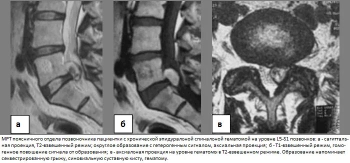 Спинальная нестабильность что это. Эпидуральный абсцесс позвоночника кт. Эпидуральная гематома позвоночника. Дуральный мешок шейного позвонка. Дуральный мешок позвоночника шейного отдела.