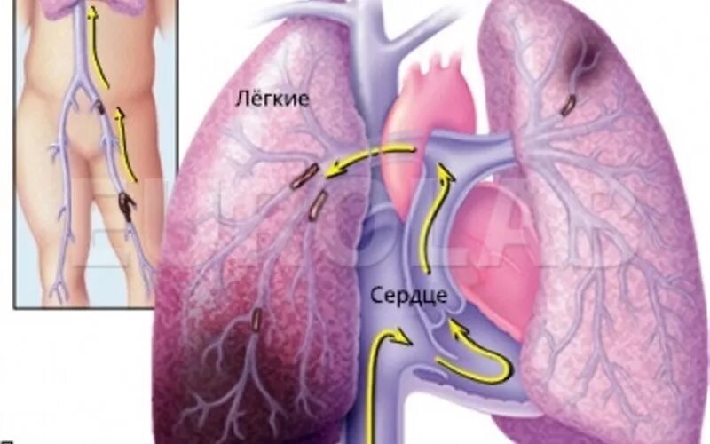 Тромбоэмболия легочной артерии. Тромбоэмболия артерии. Тромбоз легочной артерии. Тромболегочная эмболия