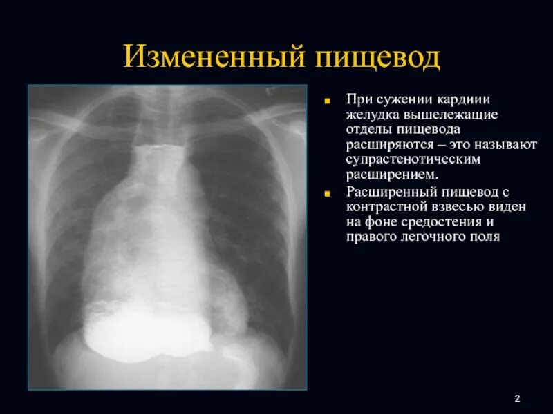 5 отделов пищевода. Супрастенотическое расширение пищевода. Стеноз пищевода с супрастенотическим расширением. Супрастенотическое расширение желудка.