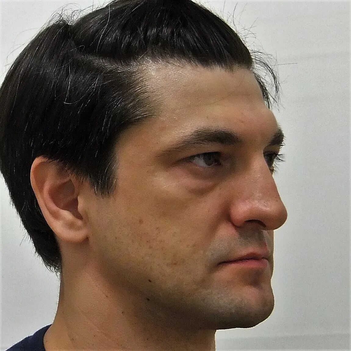 Выпуклый выступающий. Низкий покатый лоб. Маленький подбородок. Выпуклый выступающий. Дистадьный прикуса до и после.