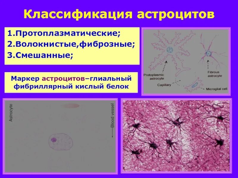 Астроцит клиника. Протоплазматические и волокнистые астроциты. Астроциты (волокнистые и плазматические). Типы астроцитов. Волокнистые астроциты строение.