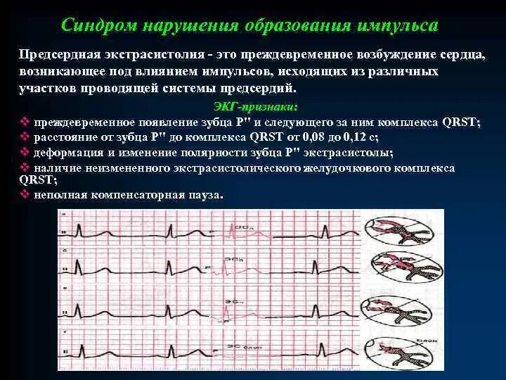 Экстрасистолия сердца симптомы и лечение у взрослых. Предсердные и желудочковые экстрасистолы. предсердная экстрасистолия на экг. экг-критерий желудочковой экстрасистолии. предсердные экстрасистолы на экг.