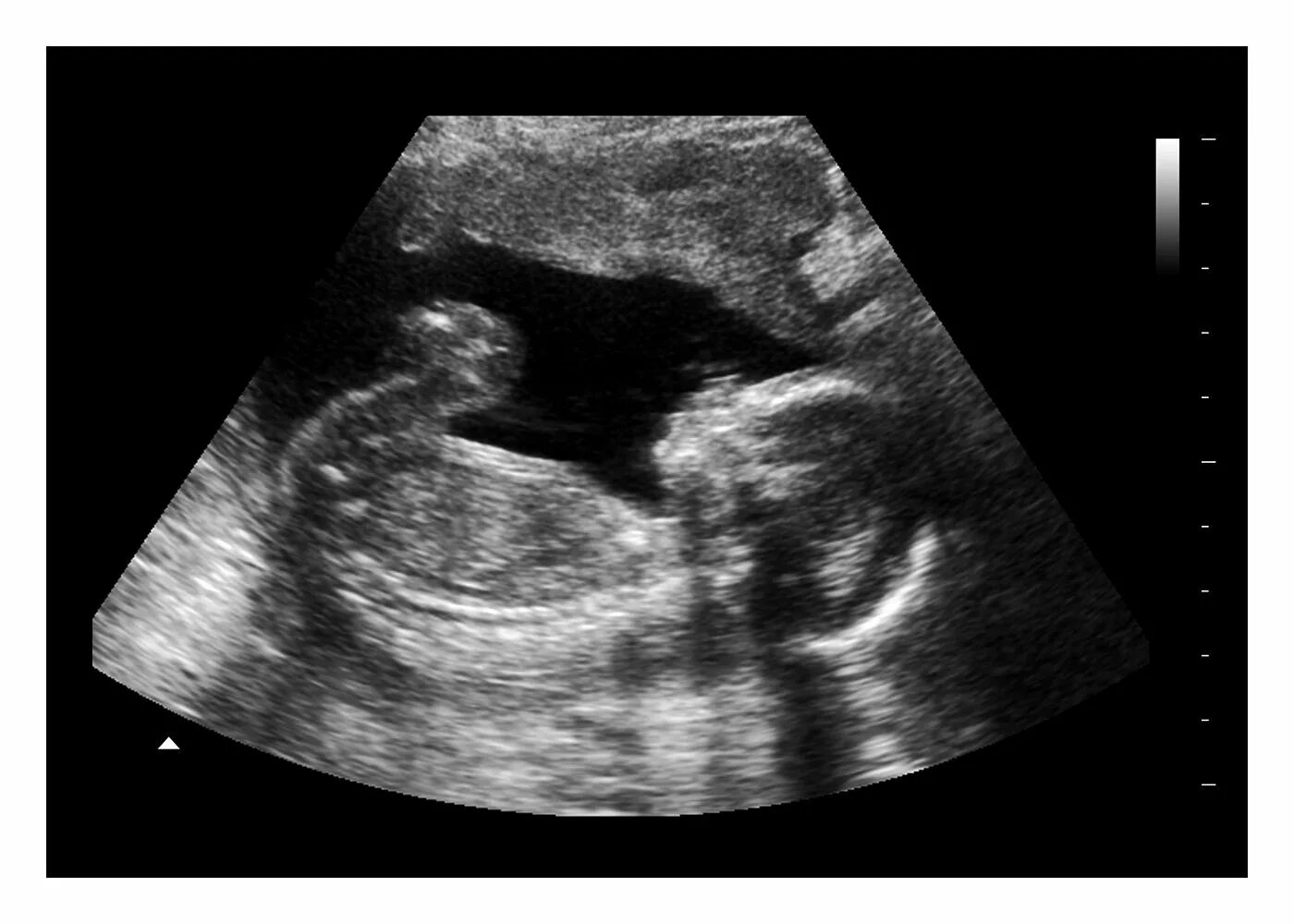 УЗИ 15 недель беременности. Картинки УЗИ малыша. УЗД дети 2023. 17 неделя 2023