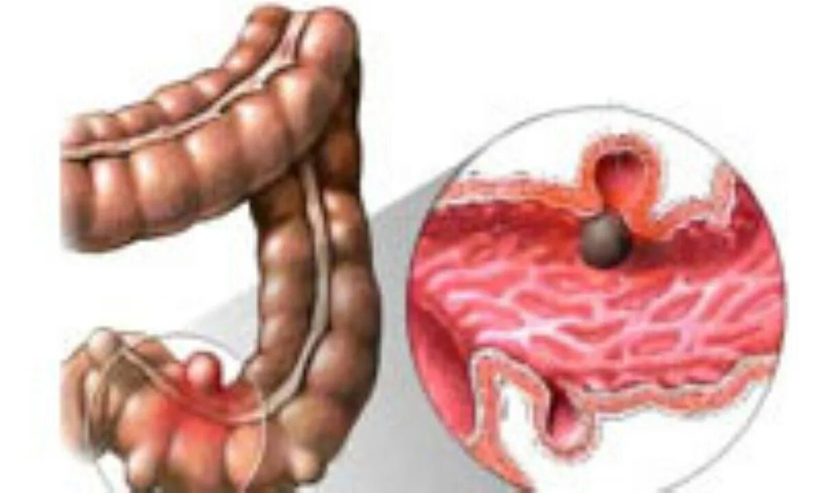 Дивертикулез толстой кишки. Дивертикулёз сигмовидной кишки. Дивертикулит сигмовидной кишки. Дивертикулы сигмовидной кишки. Что такое перфорация кишечника