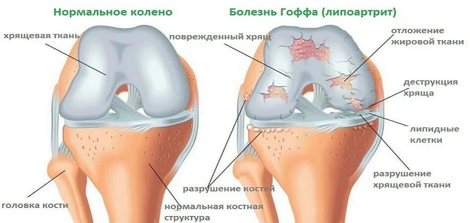 Отек гоффа коленного сустава. Жировое тело Гоффа коленный сустав. Болезнь Гоффа коленного. Клетчатка жирового тела Гоффа. Синдром жирового тела Гоффа коленного сустава.