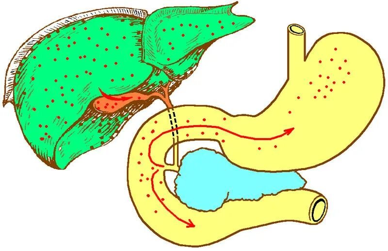 Дуоденальный гастрит рефлюкс. Деудеогастральный рефлюкс. Дуодено-гастральный рефлюкс. Дулденргастральный рефлекс. Язва 12 перстной кишки с кровотечением.