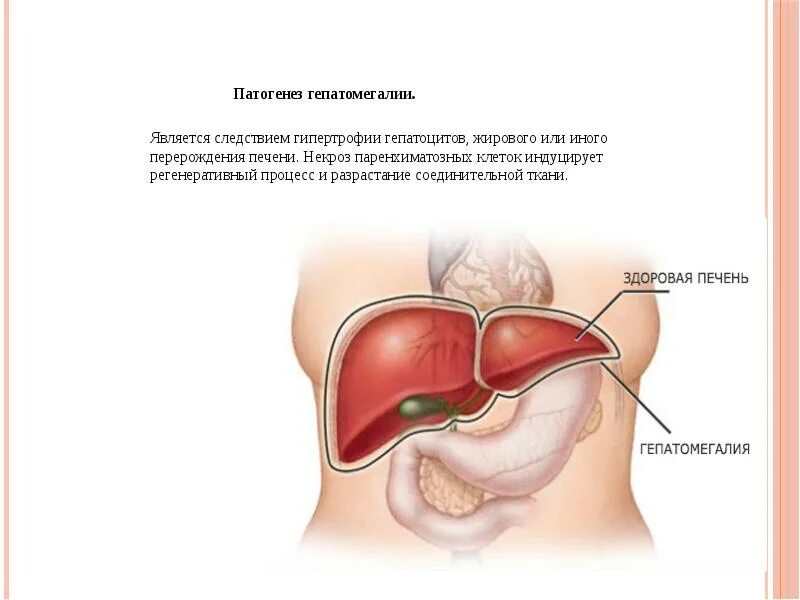 Гепатомегалия печени и поджелудочной железы что это. Гепатомегалия синдром патогенез. Патогенез гепатомегалии. Гепатомегалия механизм развития. Дифференциальный диагноз гепатомегалии.