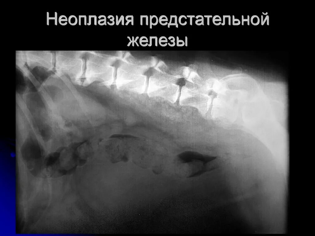 Неоплазия лечение. Простатическая интраэпителиальная неоплазия. Цервикальная неоплазия. Внутриэпителиальная неоплазия.