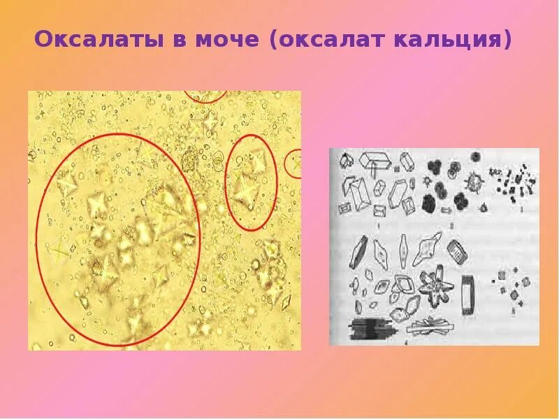 Оксалаты кальция в моче у мужчин. Кристаллы оксалата кальция микроскопия. Соли оксалата кальция. Оксалаты кальция в моче под микроскопом. Оксалаты микроскопия мочи.