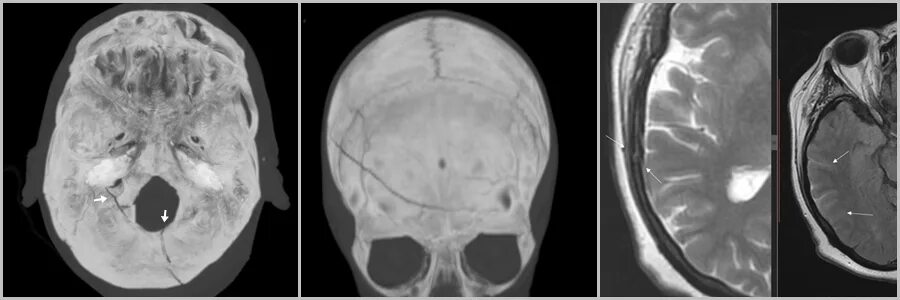 вдавленные переломы костей черепа. височный перелом черепа. Vomer bone. перелом височной кости и основания черепа. клиновидная кость и максилла.