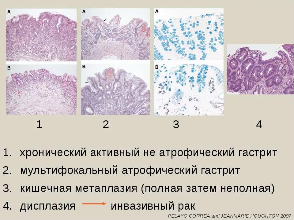 Эрозивный гастрит микропрепарат. Метаплазия желудка гистология. Мультифокальный атрофический гастрит. Атрофия слизистой оболочки тела желудка. Атрофический гастрит патанатомия.