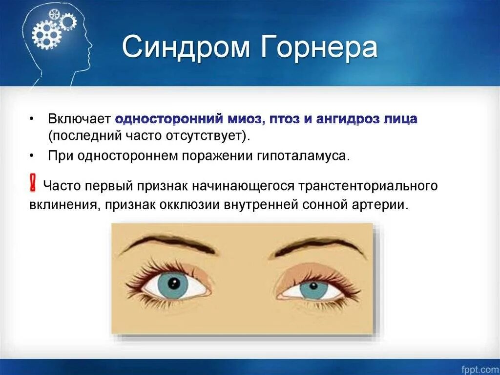 Синдром горнера это. Симптом бернара горнера. синдром клода бернара горнера. симптомы синдрома клода бернара горнера. синдром горнера неврология.