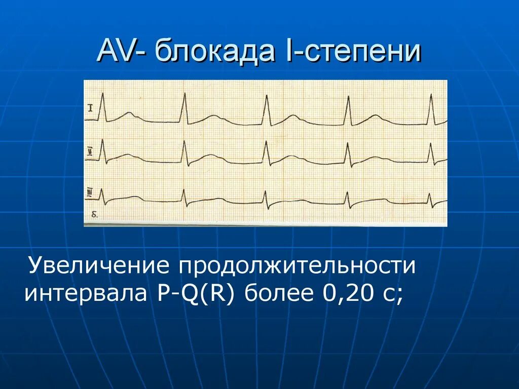 Увеличение интервала pq. АВ блокада 1 степени на ЭКГ. Неполная АВ блокада 1 степени на ЭКГ. ЭКГ при АВ блокаде 1 степени. Атриовентрикулярная блокада 1 степени на ЭКГ.