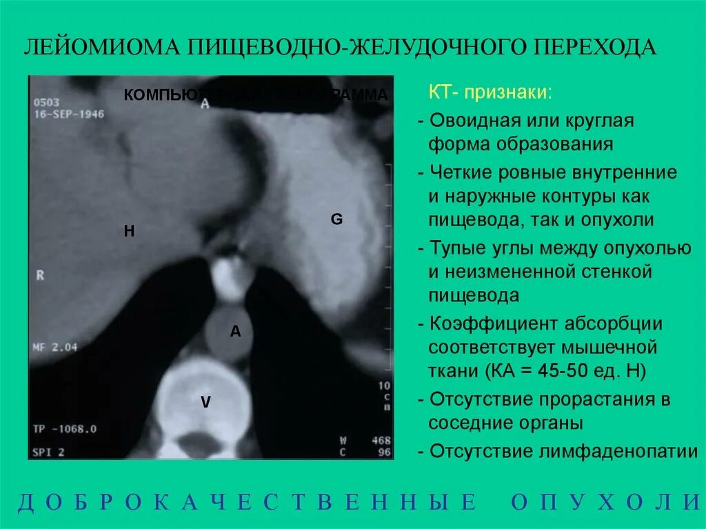 Образование пищевода на кт. Утолщение стенок пищевода кт. Кт пищевода и желудка