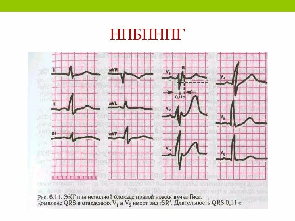 Сердце неполная блокада правой ножки гиса. Блокада правой ножки пучка Гиса на ЭКГ. Блокада левой ножки пучка Гиса на ЭКГ. Блокада ножек пучка Гиса на ЭКГ. ЭКГ критерии блокады левой ножки пучка Гиса.