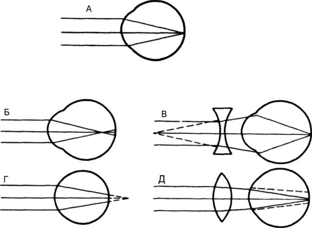 Глаз очки дальнозоркость и близорукость. Статическая рефракция глаза. Миопия схема глаза. Рефракция глаза близорукость. Схема рефракции в близоруком глазу.