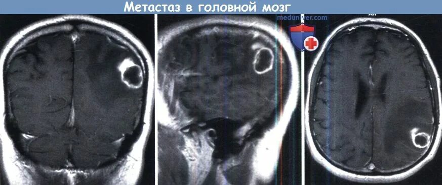 Метастазы в головном мозге гиподенсные. Единичный метастаз в головном мозге. Метастазы меланомы в головной мозг. Метастазы в головном мозге симптомы.