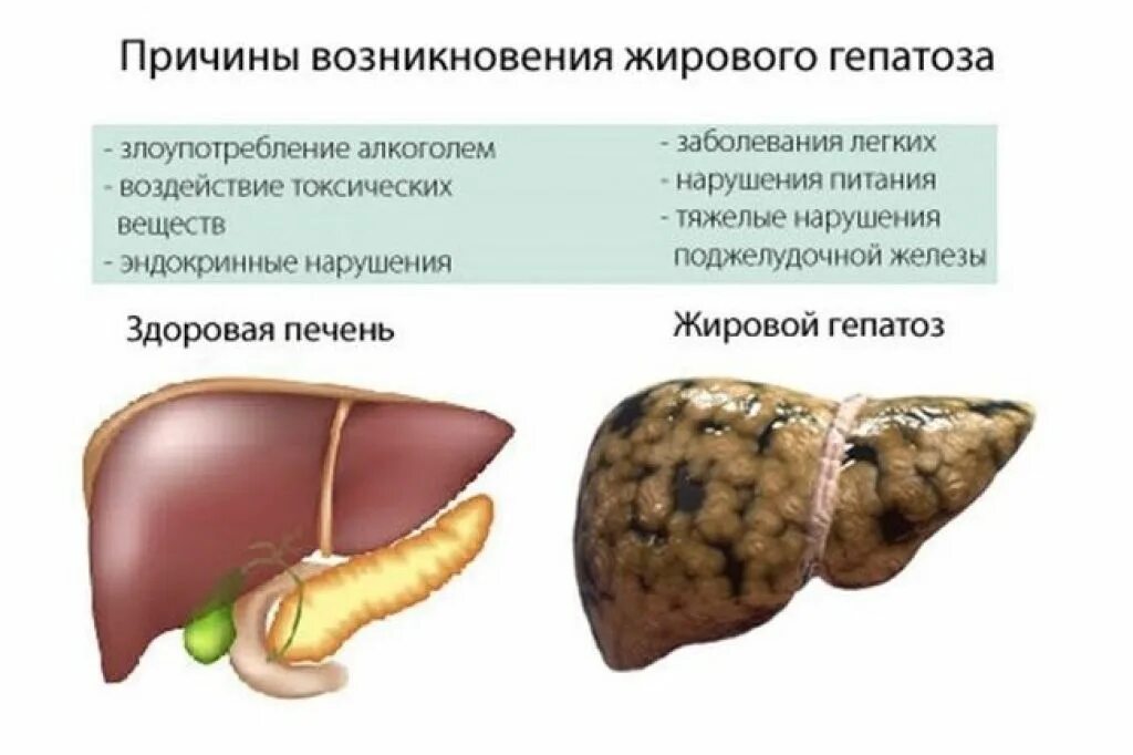 Причины и лечение жирового гепатоза печени