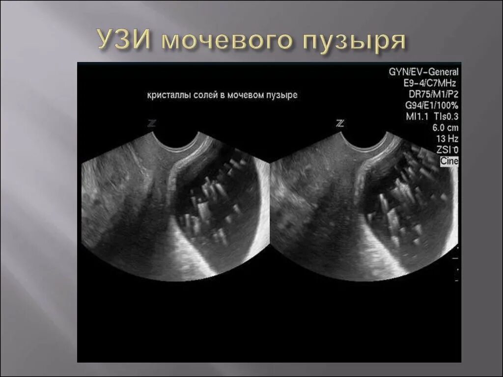 УЗИ органов мочевыделительной системы. УЗИ мочевого пузыря у женщин.