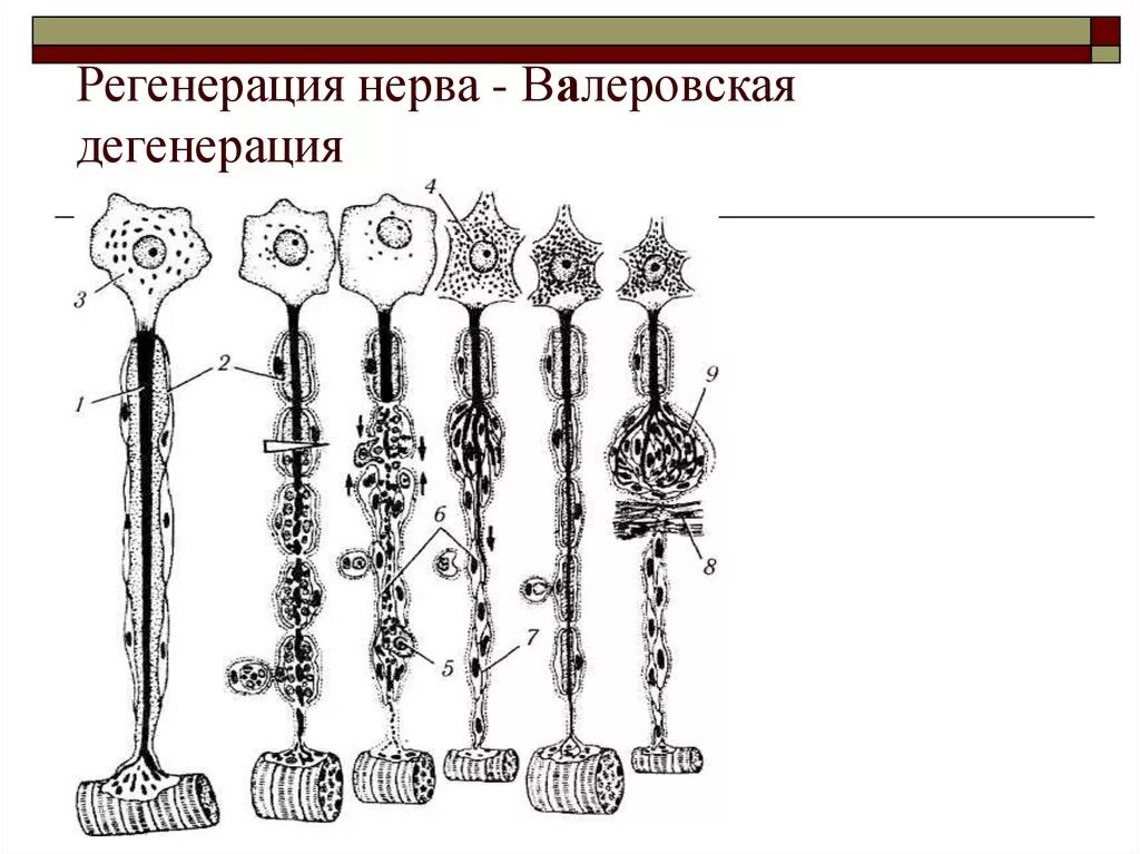 Валлеровская дегенерация нерва. Регенерация нервного волокна схема. Валлеровская дегенерация аксонов. Регенерация периферического нерва.