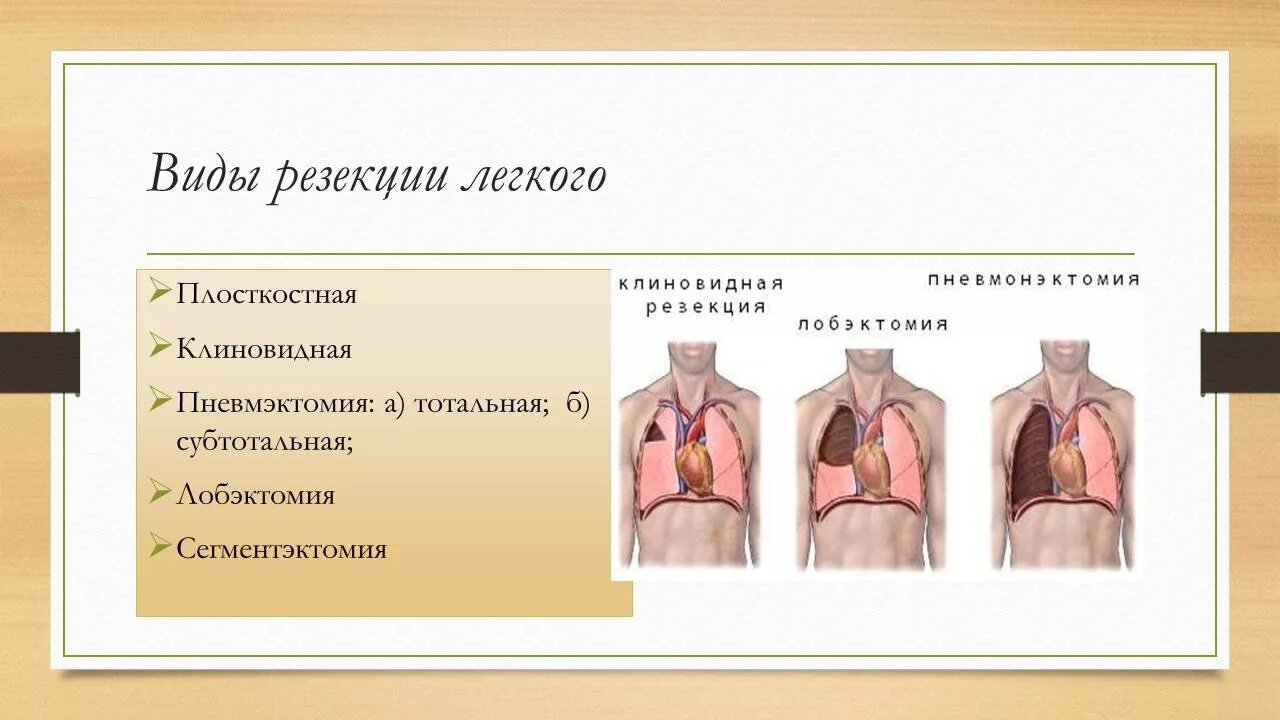 Лобэктомия что это. Резекция части легкого. Атипичная резекция лёгкого.