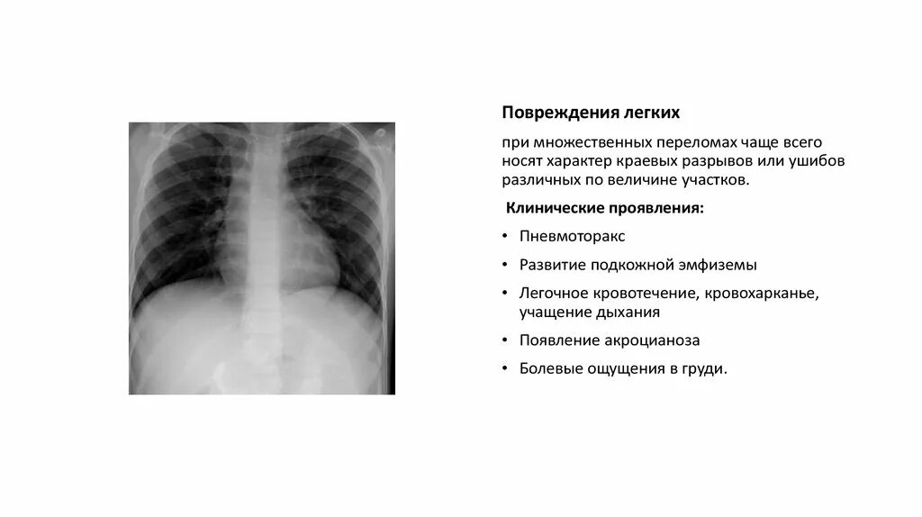 Повреждение легкого ребрами