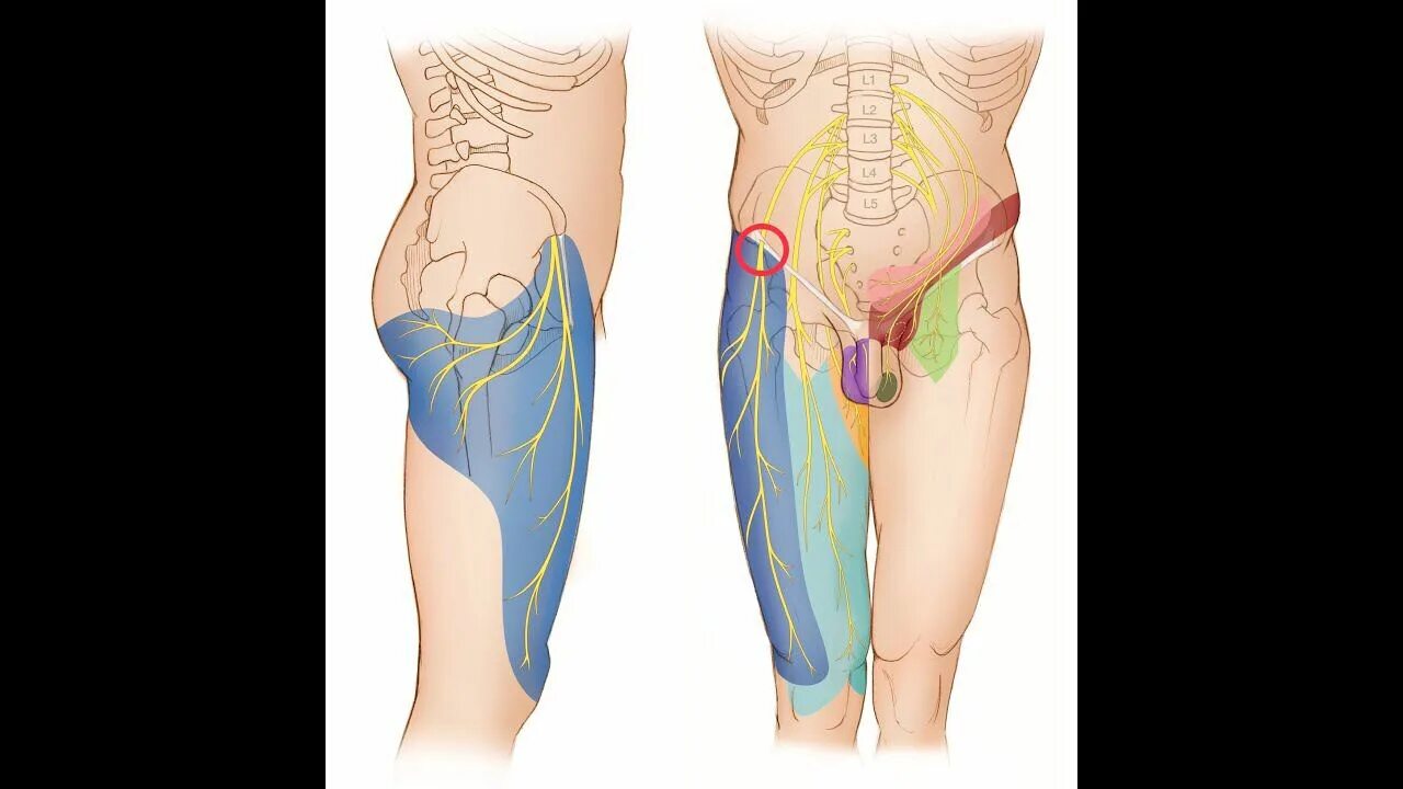 Невропатия бедра нерва. Мералгия рота Бернгардта. Парестетическая мералгия. Парестетическая мералгия бедра. Парастетическая миалгия.