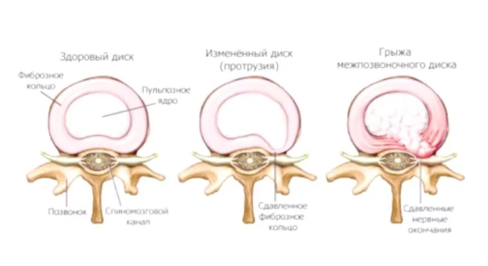Медианно парамедианная билатеральная. Задняя медианная грыжа l2 l3. Грыжа межпозвонкового диска с секвестрацией. Протрузии и экструзии. Экструзия диска l5-s1 что это такое.