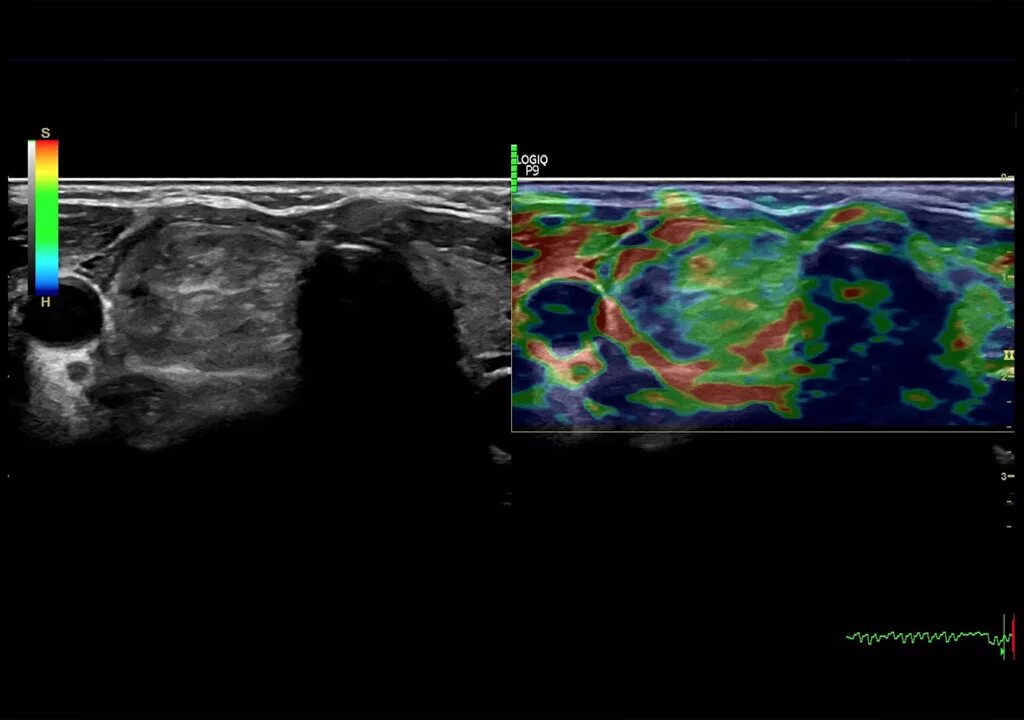 Эластография щитовидной железы что это. Эластография сдвиговой волны. Ультразвуковая компрессионная эластография. УЗИ молочных желез эластография. Ультразвуковая эластография щитовидной железы.