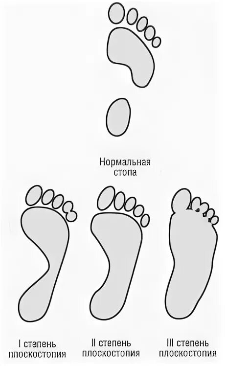 Плоскостопие второй степени берут ли в армию. Плоскостопие 2 степени 3 степени в армию. Плоскостопие 2 степени армия. Продольное плоскостопие 2 степени армия. Плоскостопие 2 степени уплощение стопы.