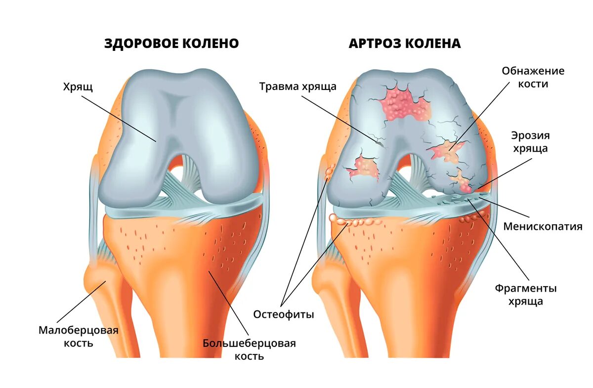 Что разрушает суставы. Повреждение хряща коленного сустава. Деформация остеоартроза коленного сустава. Суставные хрящи коленного сустава. Разрыв хряща коленного сустава.