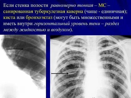 Полость при туберкулезе легких