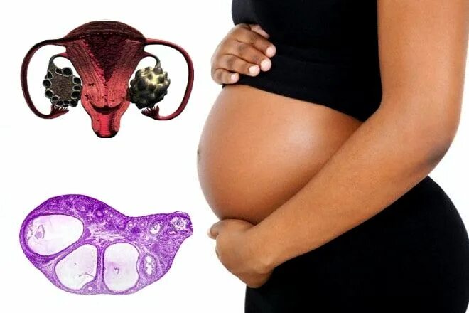 Яичники при беременности. Девушки с поликистозом.