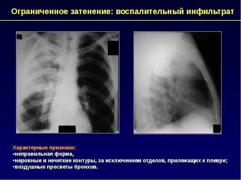 Нечеткие контуры легкого. Очаговая тень туберкулез. Нечеткие неровные контуры. Нечеткие контуры легкого. Интерстициальный отёк лёгких рентген.