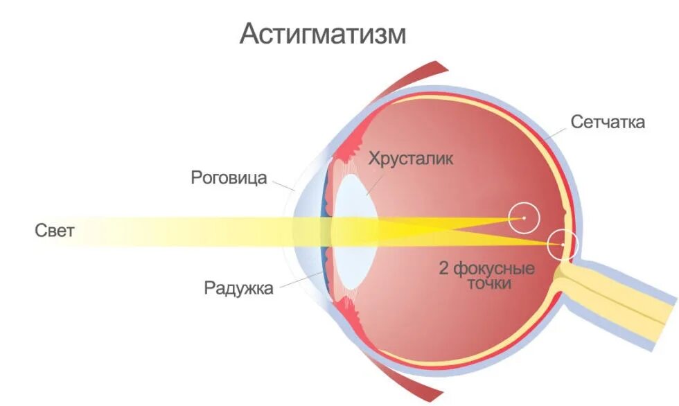 Миопический астигматизм слабой степени. Астигматизм сложный миопический слабой степени ou. Астигматизм -3.5. Астигматизм схема. Сложный гиперметропический астигматизм глаз