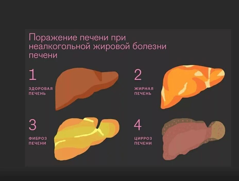 Неалкогольная жировая болезнь печени стадии. Жировой гепатоз 1 степени. Неалкогольный жировой гепатоз. Жировой гепатоз 2 степени.