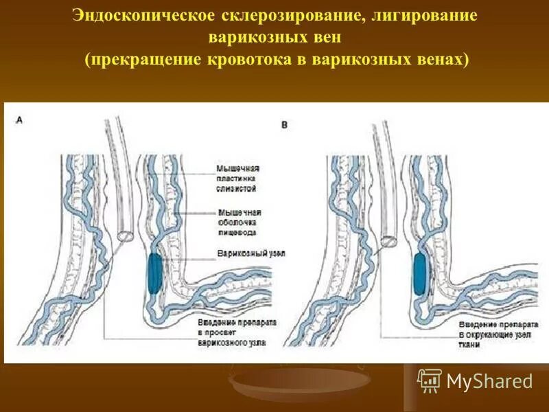 Лечение варикозного расширения пищевода