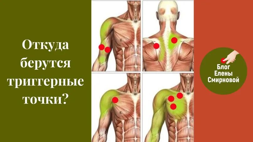Триггерные точки. Триггерная точка в мышцах. Триггерные точки симптомы. Терапия триггерных точек. Триггерные точки это простыми словами