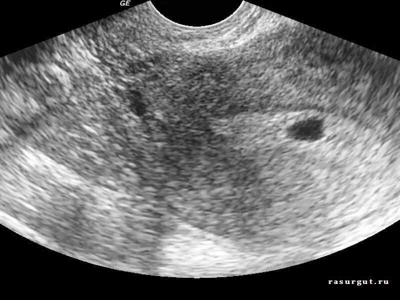 Внематочная Трубная беременность УЗИ. Внематочная беременность снимки УЗИ. Внематочная беременность УЗД. Внематочная беременность плодное яйцо.