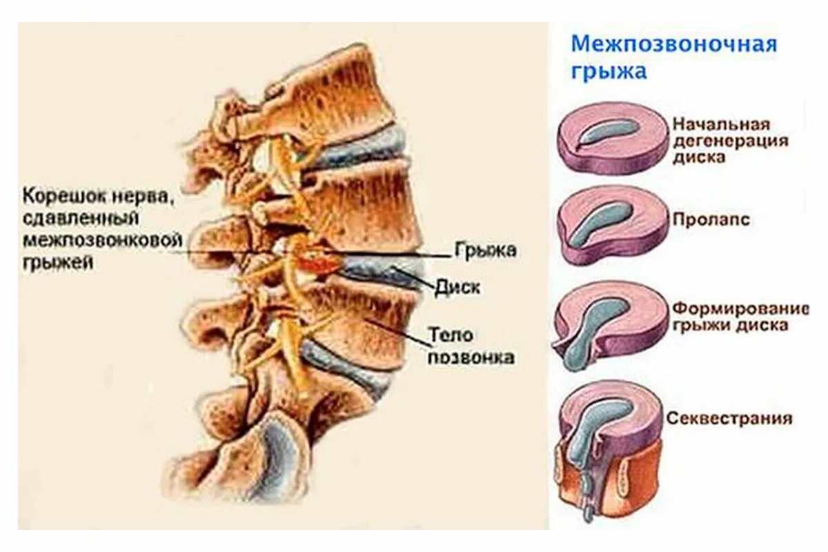 Дегенерация дисков. Позвоночная грыжа l1-l2. Секвестрированная грыжа межпозвоночных дисков. Грыжа межпозвонкового диска с секвестрацией. Грыжи позвоночника в поясничном отделе схема.