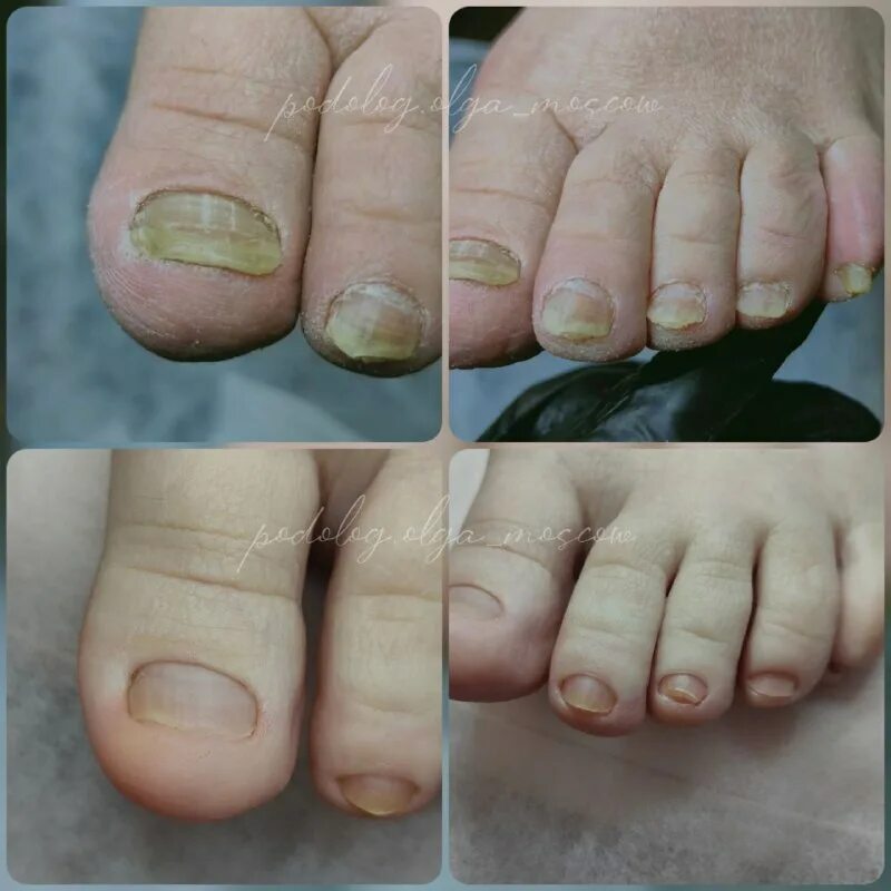 обрезной маникюр травмы. изменения ногтей заболевания. грибок ногтей на ногах симптомы. исследование ногтевой пластины. грибковые болезни ногтей.