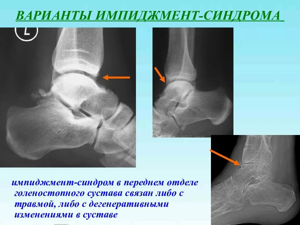 Голеностопный сустав инвалидность. Импиджмент синдром голеностопного сустава. Импиджмент синдром таранной кости. Задний импинджмент голеностопного сустава рентген. Передний импинджмент синдром голеностопного сустава рентген.