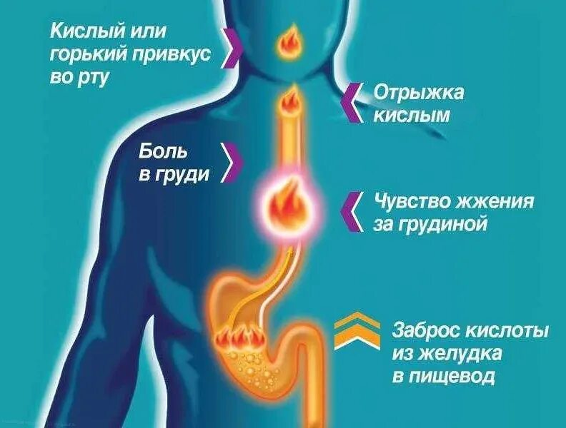 Сильная боль в животе после еды. Симптомы изжоги желудка. Основные причины изжоги.