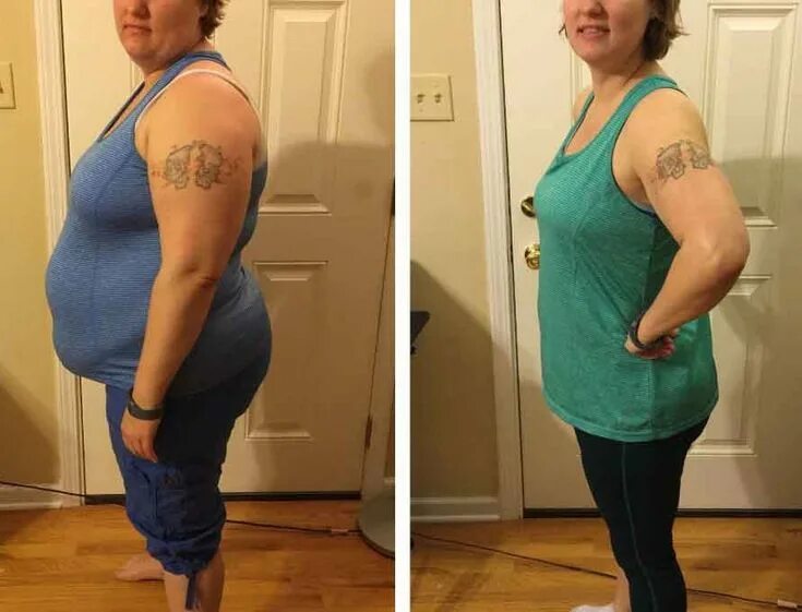 Диета до и после. Липолиз живота до и после. Худеют ли после операции. Бариатрическая операция для похудения. Живот до и после похудения.